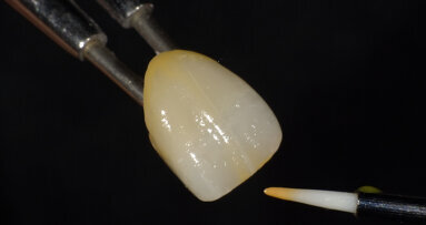 Caracterización de una restauración de cerámica híbrida