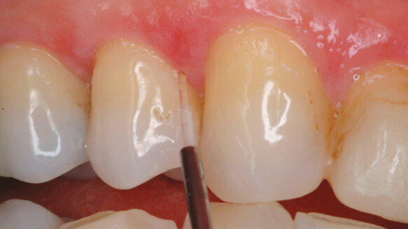 Diode lasers for periodontal treatment: the story thus far