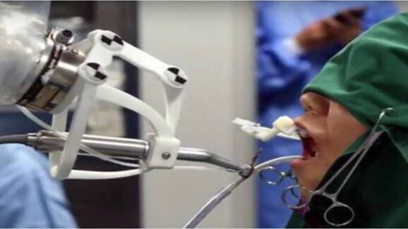 Robot independently places 3-D printed implants in a patient in China