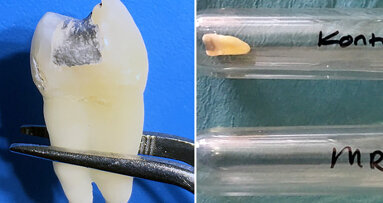 High-strength MRI may cause mercury release from amalgam dental fillings