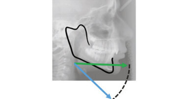 Moderate to severe Class II  malocclusion using Invisalign® treatment with mandibular advancement