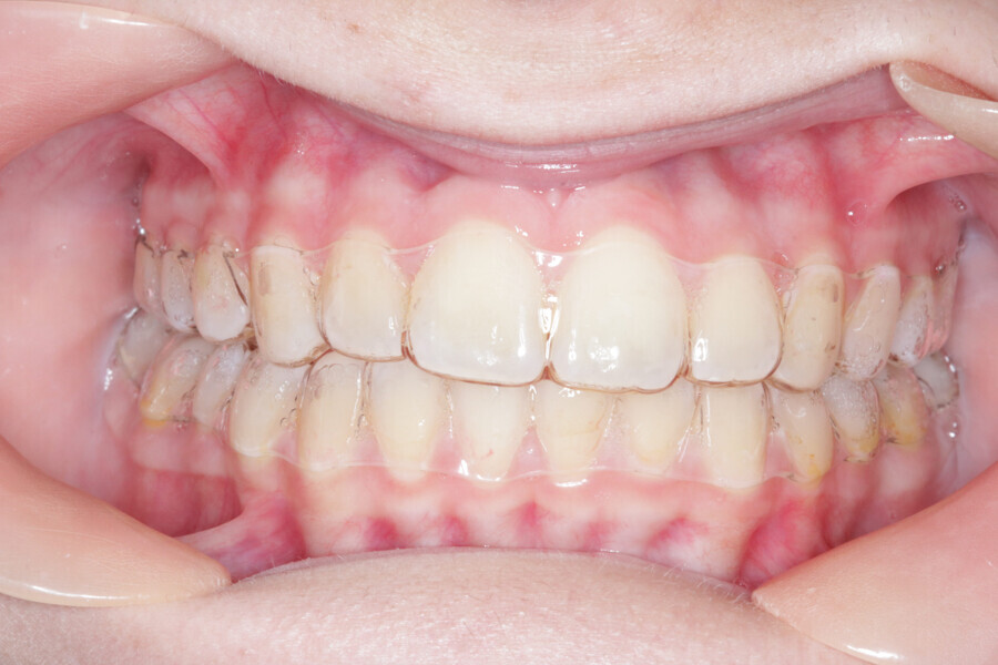 Fig. 14: Intermediate stage of Reveal aligners.