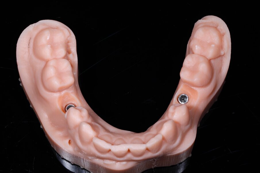 Fig. 12a_Il modello prototipato con stampante DWS XFAB realizzato in alta definizione con materiale Precisa 097 DWS technology.