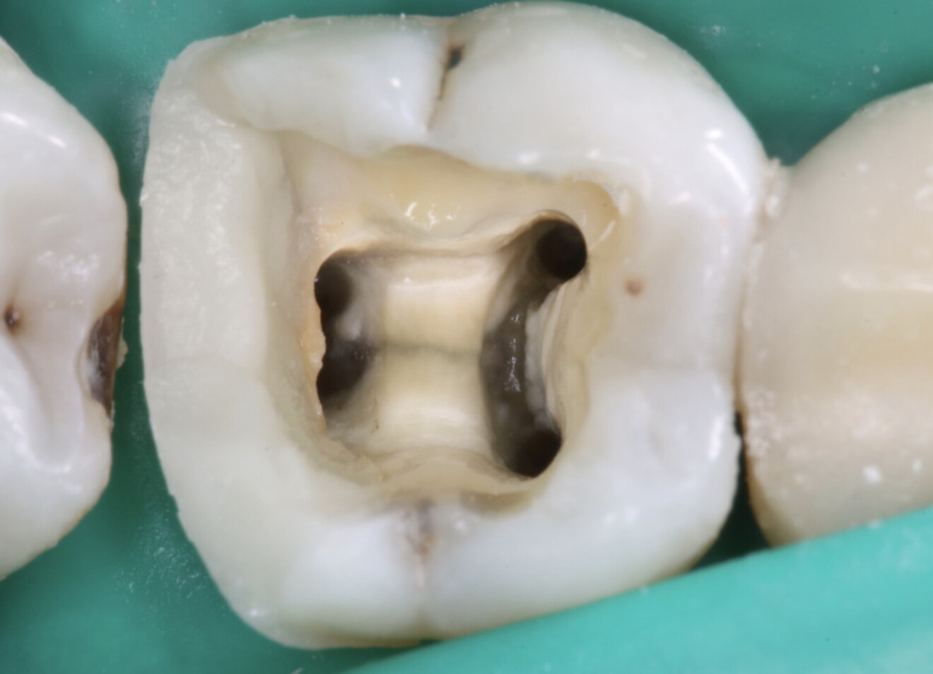 Fig. 19 : Repréparation adéquate de la cavité d’accès après une reconstruction préendodontique appropriée.