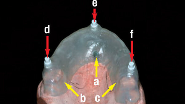TRIPODE – Un nouveau protocole pour la mise en charge immédiate de prothèses complètes sur implants