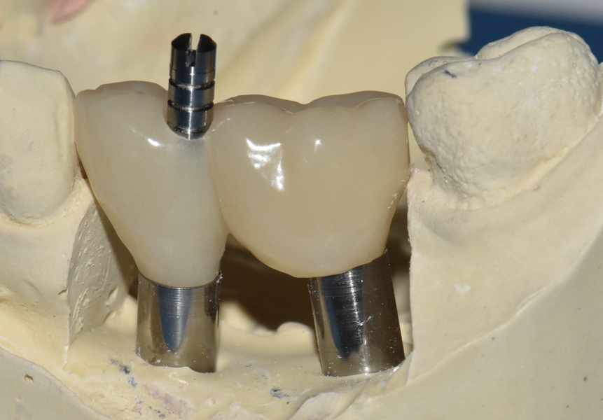 Fig. 11b : Bridge G-CAM réalisé en direct implants avec vis sphériques.