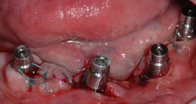 Uso del porta impronta dinamico nella protesi  a carico immediato