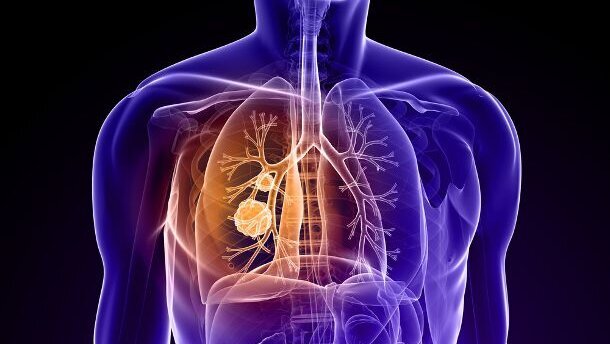 Atemtest soll Krebserkrankung erkennen
