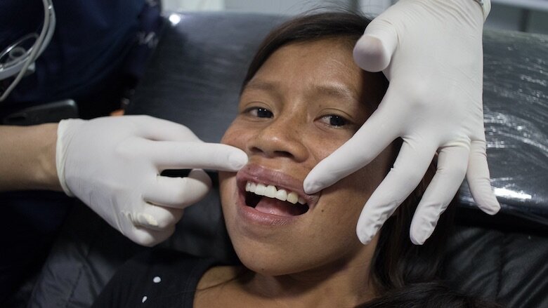 Figura 4. El resultado después de la cementación de un puente fabricado con CEREC.
