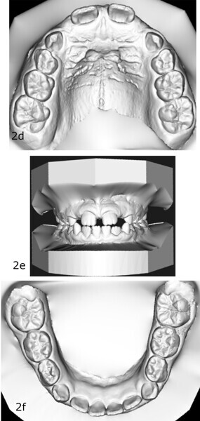 Figs. 2d–f: ... corresponding models at the start of treatment.