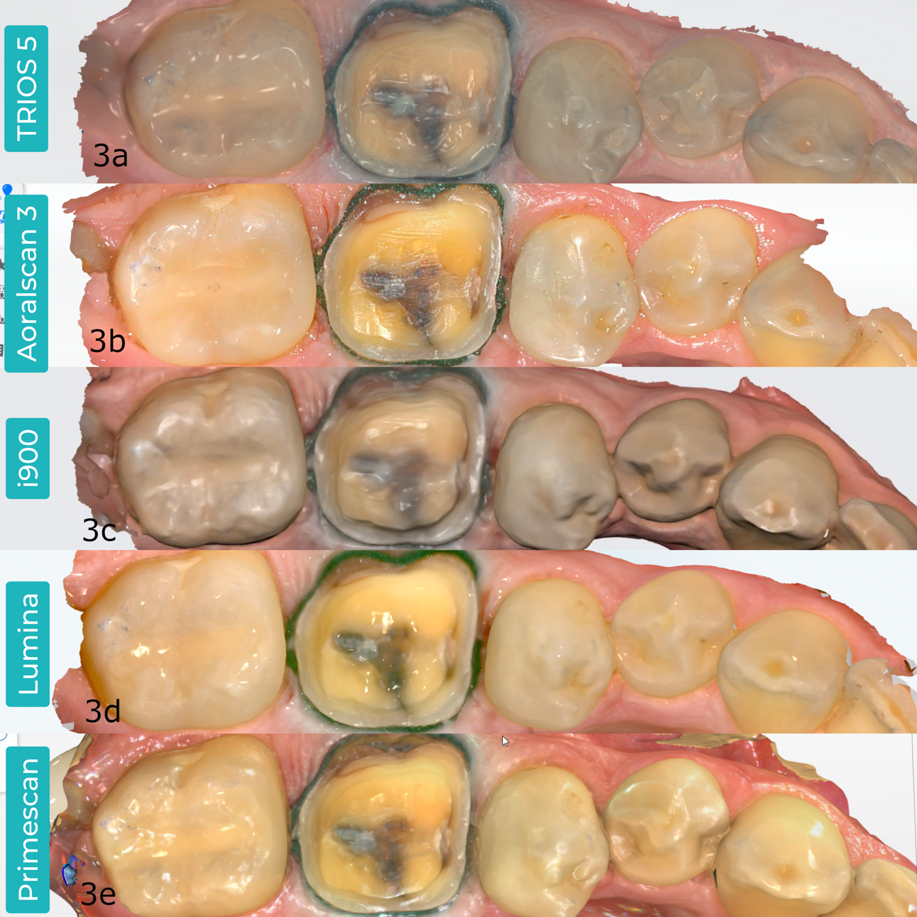 Figs. 3a–e: Processed colour scans of the same tooth preparation, previewed in the scanners’ native software. TRIOS 5 (a). Aoralscan 3 (b). Medit i900 (c). ITero Lumina (d). CEREC Primescan (e).