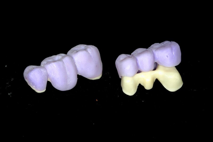 Fig. 21: Milled zirconium oxide framework and ground lithium disilicate veneering structure