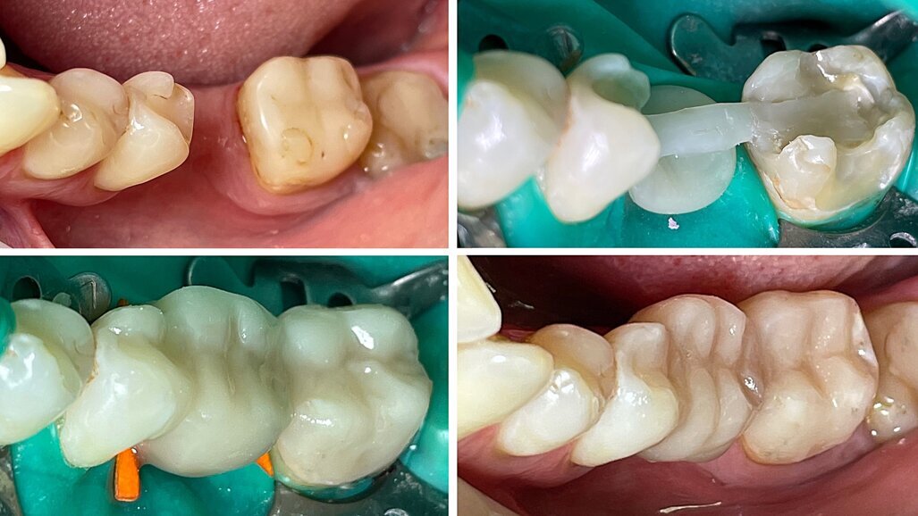 El puente reforzado como alternativa al implante