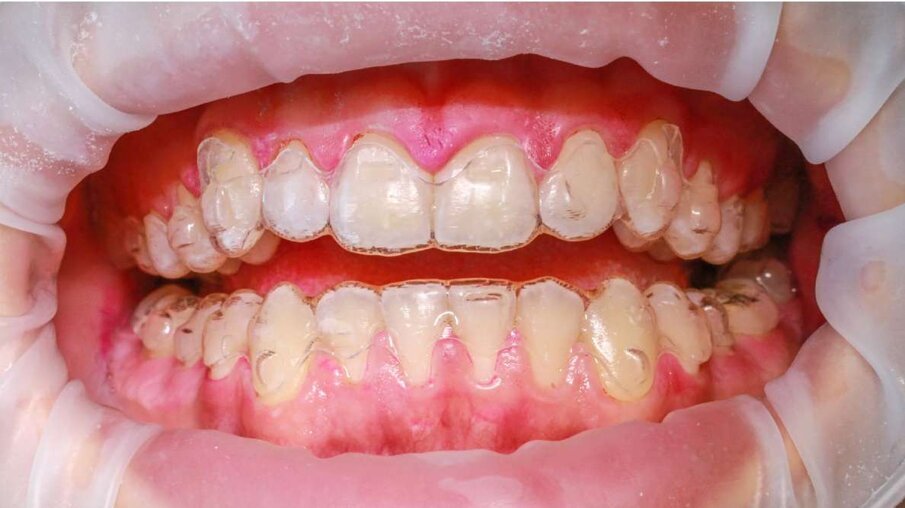 Fig. 9 - Dopo la pulizia con la polvere AIRFLOW PLUS, con allineatori trasparenti (© Marie-Claude Ekstand). 