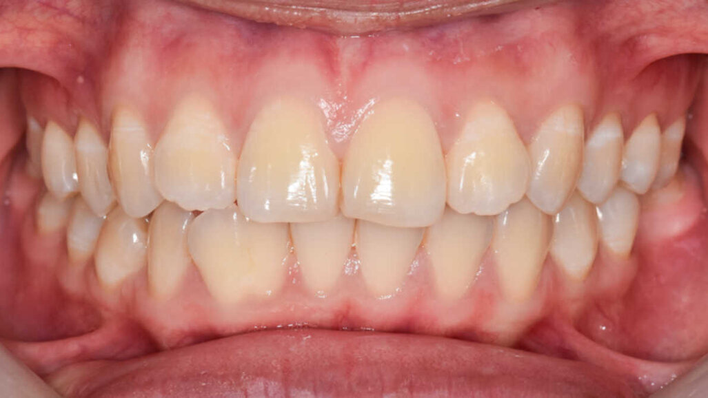 Pesquisadores descobrem como as bactérias orais podem afetar a agressividade dos cânceres de cólon