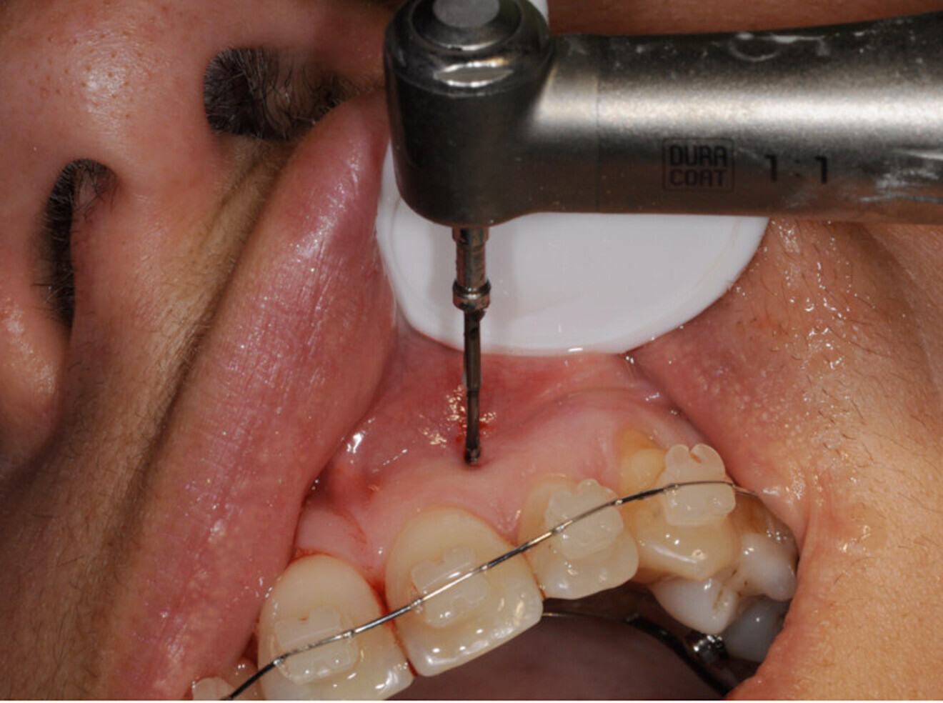 Fig. 4 : Utilisation d’un ostéotenseur rotatif afin d’initier une activation orthodontique.