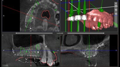 Rigenerazione ossea 3D mediante griglia in titanio CAD/CAM customizzata e chirurgia computer guidata per la riabilitazione di un grave difetto osseo localizzato