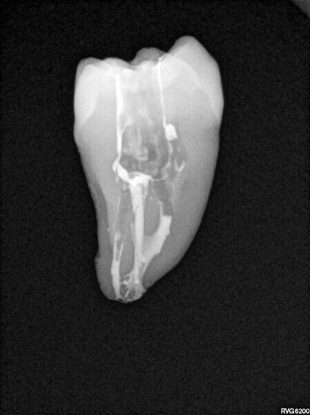 Fig. 5: Post-op radiograph of a mandibular molar.