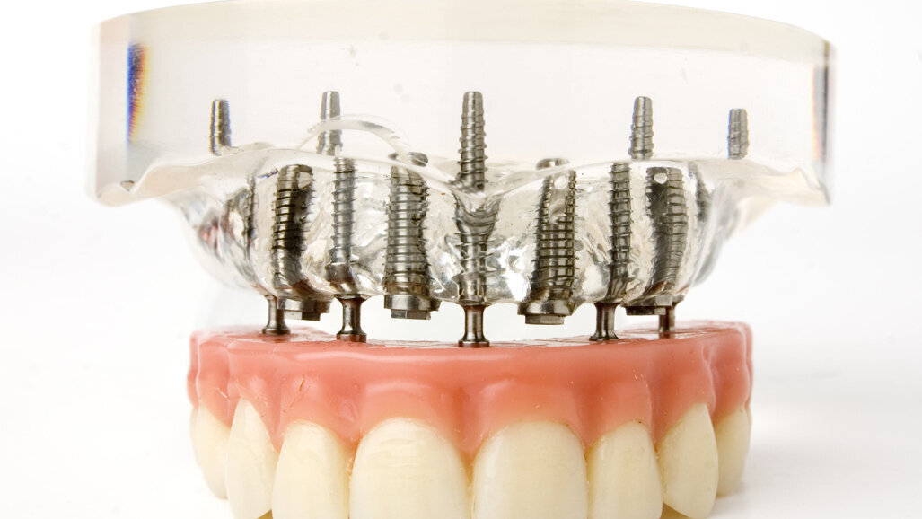 Implanteren in bovenkaak tegen kaakbotslijtage