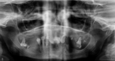 Atypowe powikłanie w leczeniu implantologicznym bezzębnej żuchwy