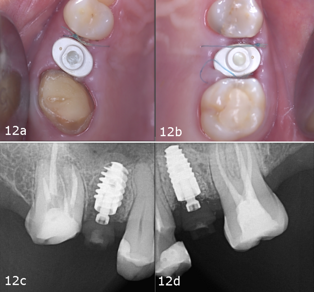 Figs. 12a–d: Intra-oral (a & b) and radiographic situation two weeks after surgery (c & d).