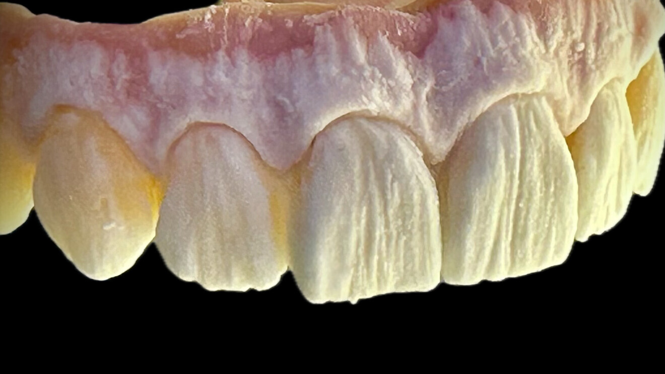 Fig. 4: Result of micro-layering with CERABIEN MiLai porcelains, LT1 for the cervical areas, as well as E2 and Tx for the middle and incisal regions, for a seamless translucency gradient, and Tissue 1, 5 and 6 for blending harmoniously with the patient’s surrounding gingivae.  