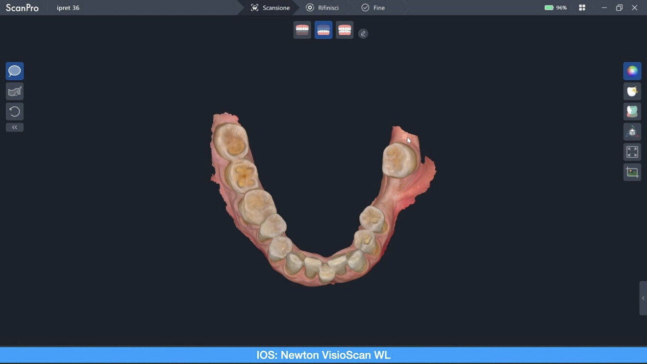Fig. 2: Intra-oral scan of the mandibular arch.