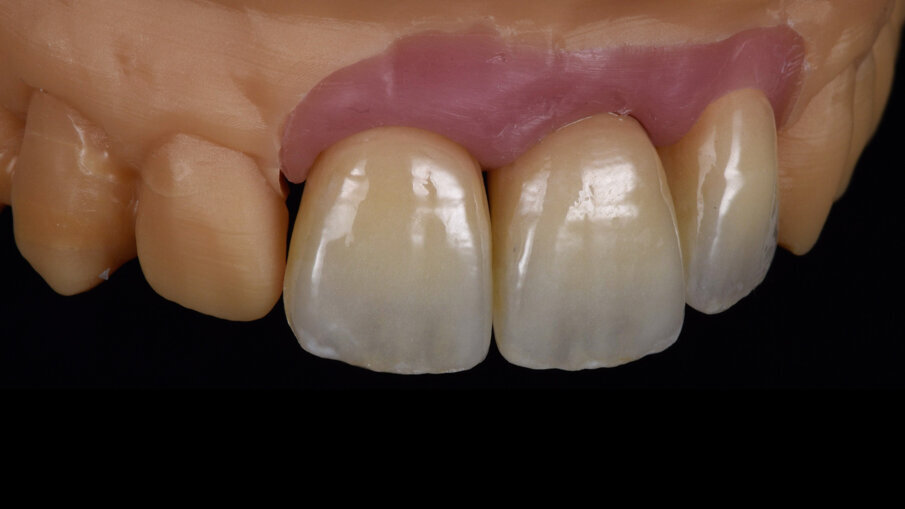 Figg. 12-14_Aspetto finale delle corone dopo le fasi di lucidatura meccanica.