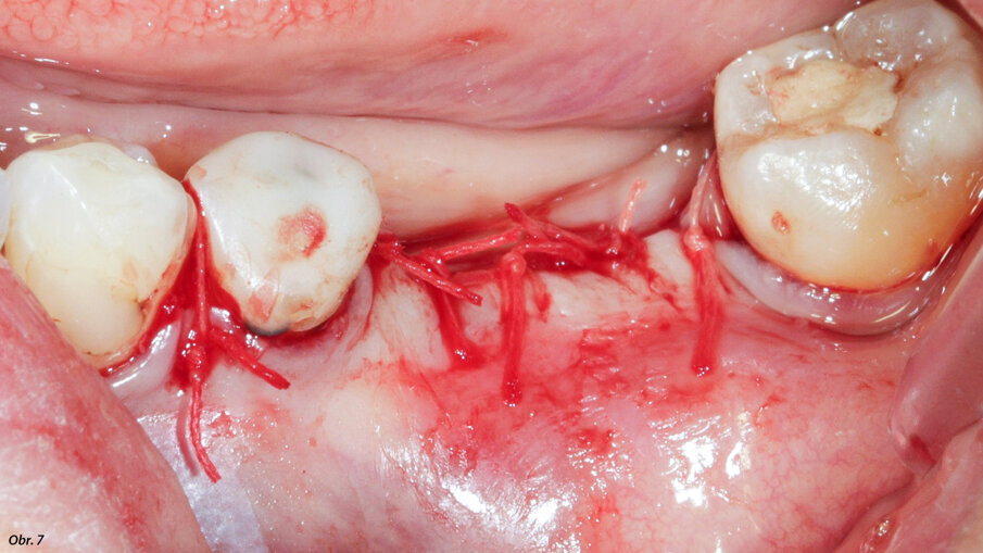 K sešití bylo použito rychle vstřebatelné splétané vlákno č. 4/0.