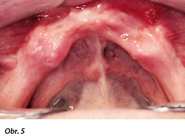 Výchozí situace: bezzubá čelist.