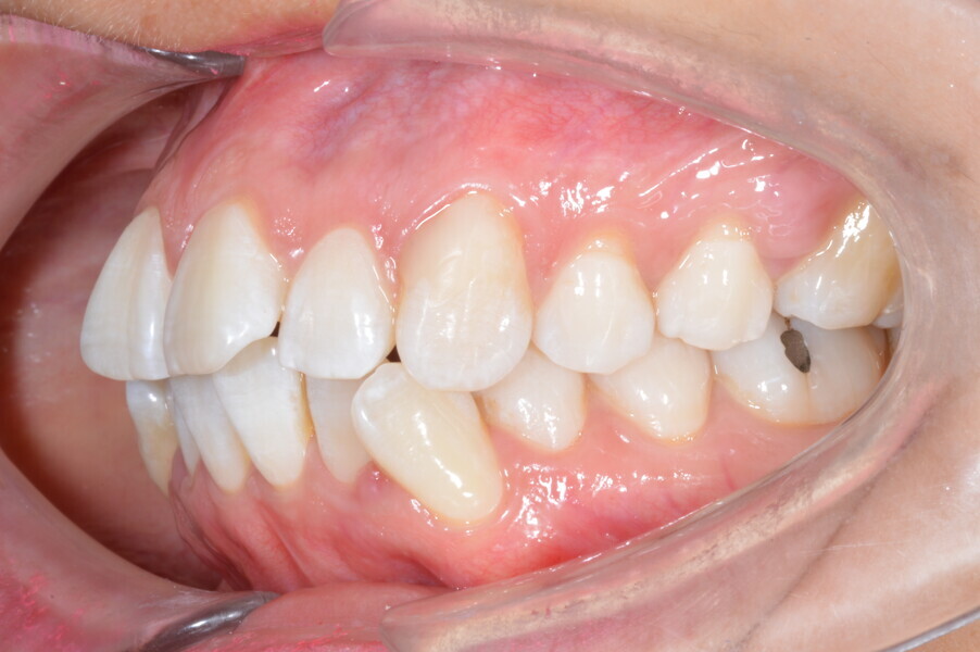 Fig. 2c: Initial intra-oral photograph.