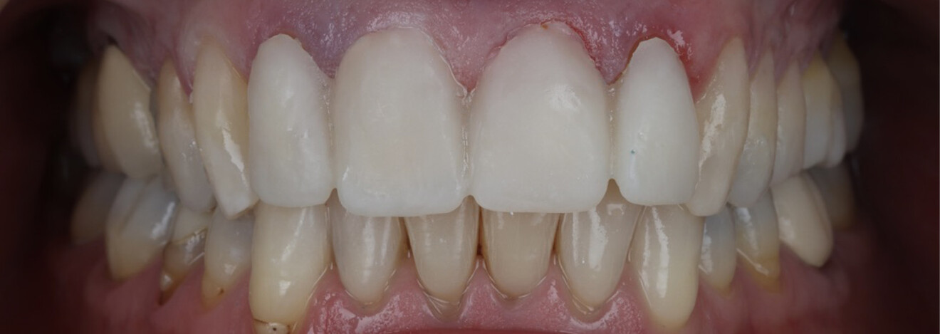 Fig. 4: Clinical situation after replacement of the Class V composite restorations on teeth #13, 23, 24 and 25.