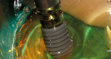 Il trattamento implantoprotesico nei pazienti  con osteoporosi in terapia con bifosfonati orali