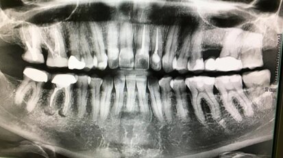 Diagnostic tips for bone lesions with DTX Studio Clinic