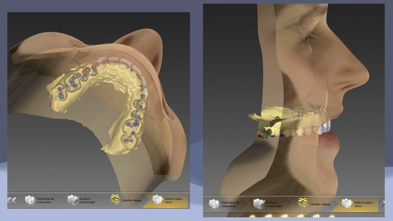 Fig. 10: Mandibular dynamics in inLab CAD SW 22.0. 