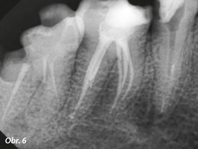 Pooperační rentgenový snímek s viditelnou obturací.