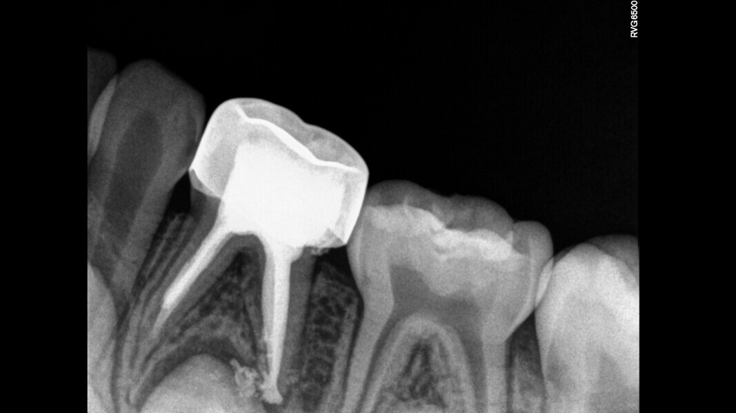 Fig. 11: Obturation and final restoration.