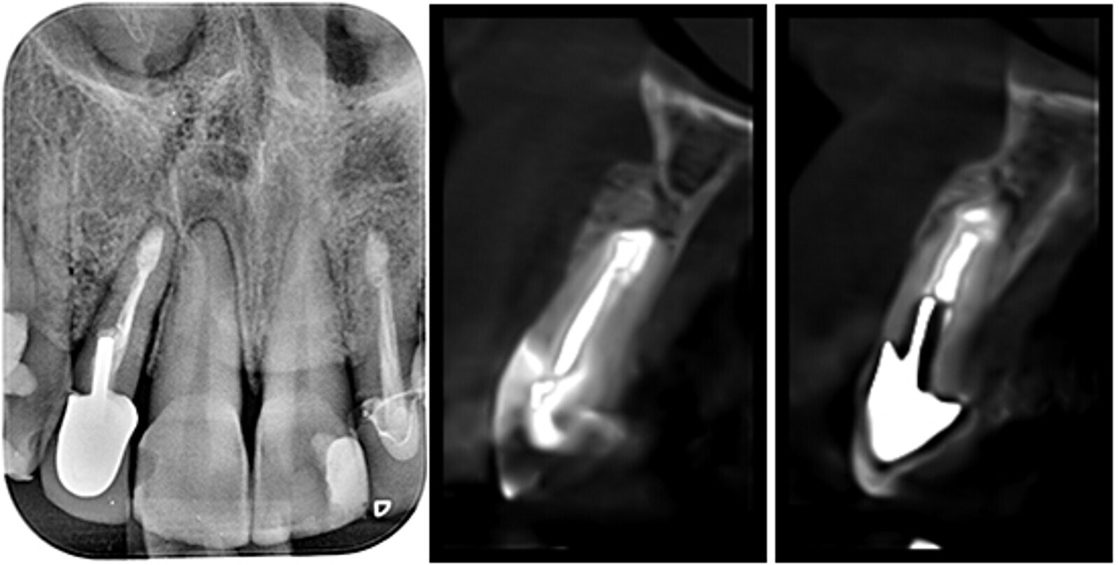 Figuras 17-20. Control clÃ­nico y radiogrÃ¡fico a los 5 aÃ±os de la cirugÃ­a periapical. Los cortes del TCHC muestran como se mantiene Ã­ntegra la cortical vestibular regenerada. 