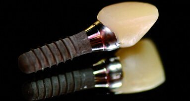 Utilizing the Tempcap abutment with CAD/CAM: Combination of Tempcap, in-office CAD/CAM and e.max allows for final restoration