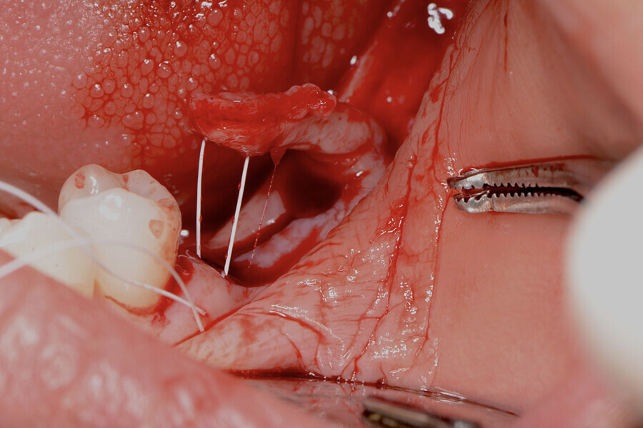 Fig. 11 : Lambeau utilisé dans la technique Snake (suture en distal). 