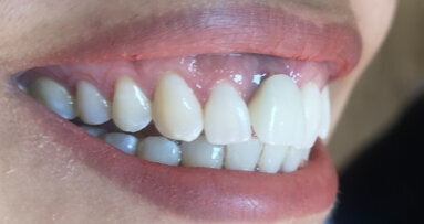 KATANA Zirconia UTML veneers and crown on zirconia implant cemented with PANAVIA Veneer LC