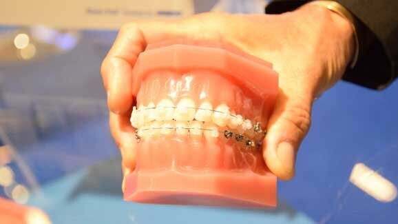 Combining aesthetics, low friction and passive self-ligation in orthodontics
