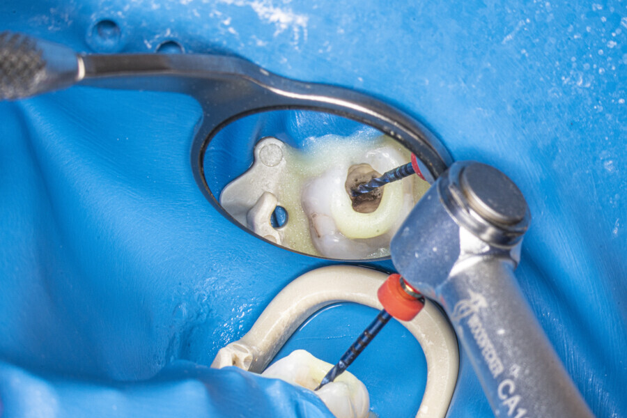 Fig. 41: Chemomechanical preparation before the Less-Prep Endo enhanced irrigation protocol.