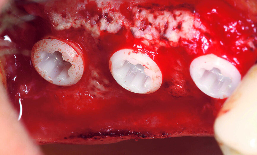 Fig. 14 : Implants insérés avec hauteur supracrestale comprise entre 0,5 mm et 1,0 mm. 