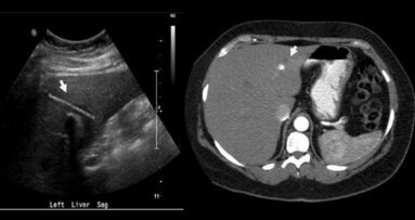 Ingeslikte tandenstoker leidt tot leverabces
