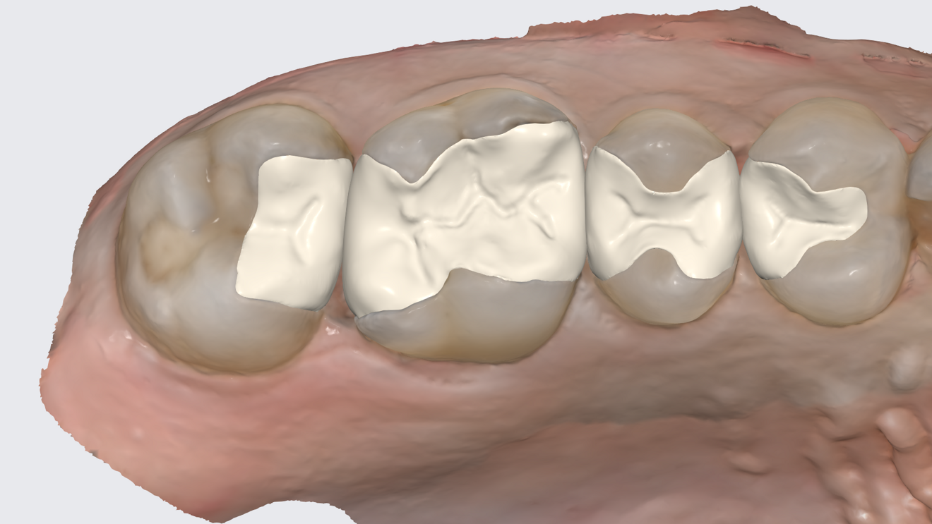 Fig. 2: Chairside design of 3D-printed restorations using Medit ClinicCAD.