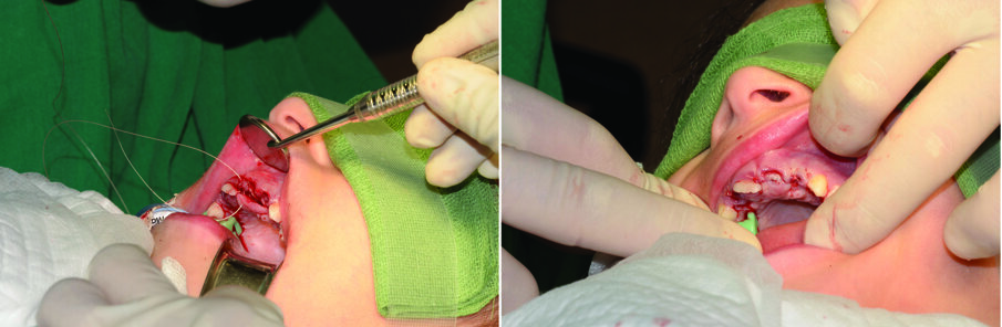 Figs. 10 (a & b). Repositioned palatal flap and wound closure with resorbable sutures. Tooth 21 is now exposed after a small apically repositioned flap