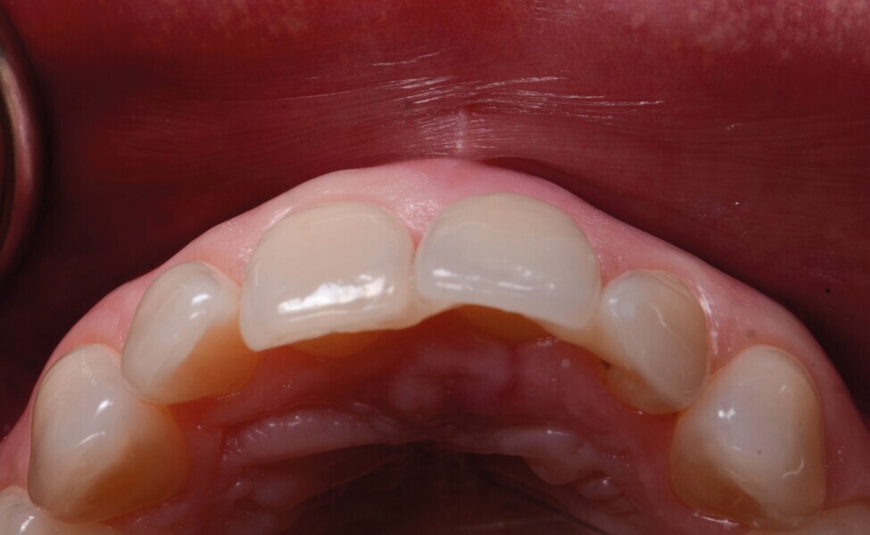Fig. 7c : Vue vestibulo-occlusale.