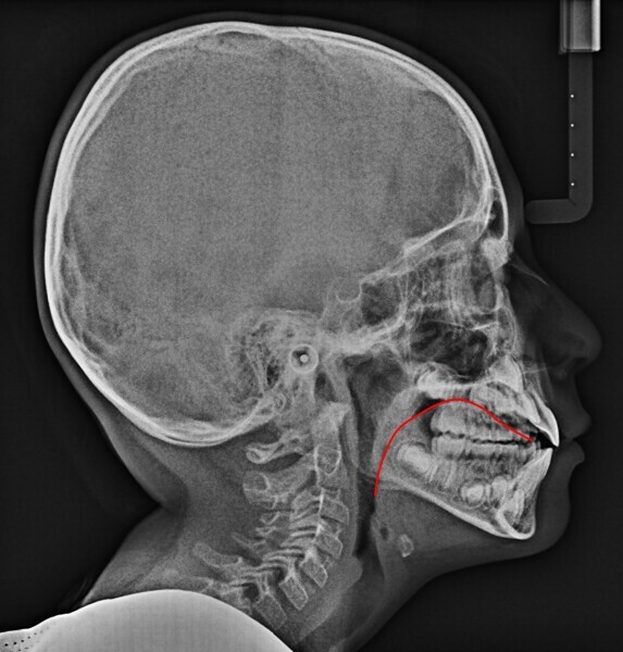 Fig. 14a: Comparison of the lingual position on the cephalometric radiograph at the (a) start (red line) and (b) end of treatment (green line).