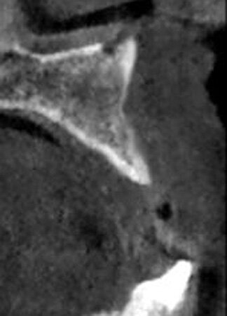 Fig. 2: CBCT cross-section demonstrating insufficient ridge width facial-palatally to permit implant placement in the healed extraction sites.